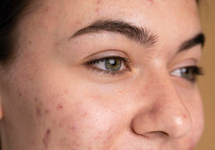 Dark Spots and Hyperpigmentation